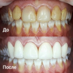 Замена старых композитных реставраций на керамические виниры и безметалловые коронки