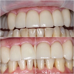 Устранение эстетических недостатков центральной группы зубов от 'клыка до клыка' керамическими винирами EMAX цвет A1 VITA